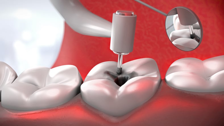 dentist's drill treating a sick tooth