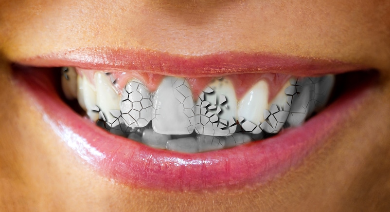 Woman with cracks on her teeth