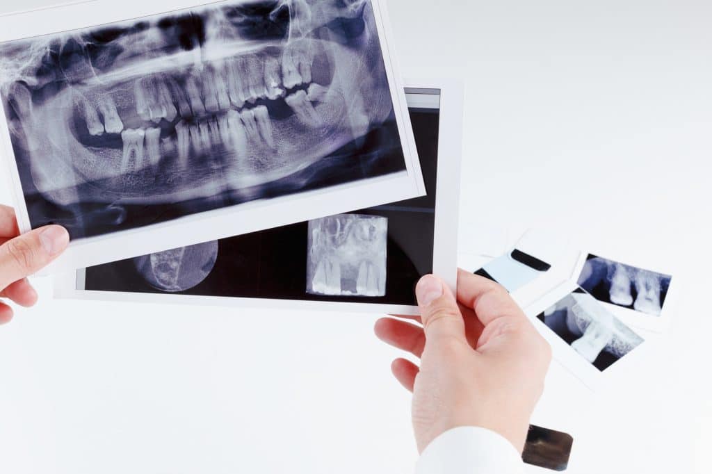 Benefits Of Dental X Rays — Pickering, ON