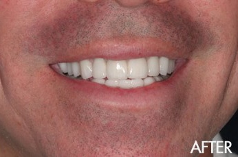 After photograph from smile gallery example 1