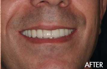 After photograph from smile gallery example 6