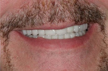 After photograph from smile gallery example 3