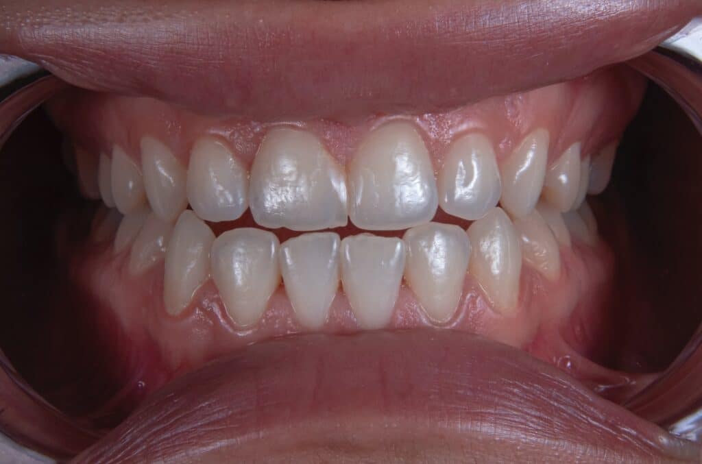 Invisalign