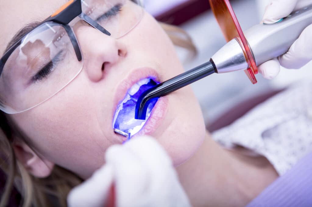 dental fillings
