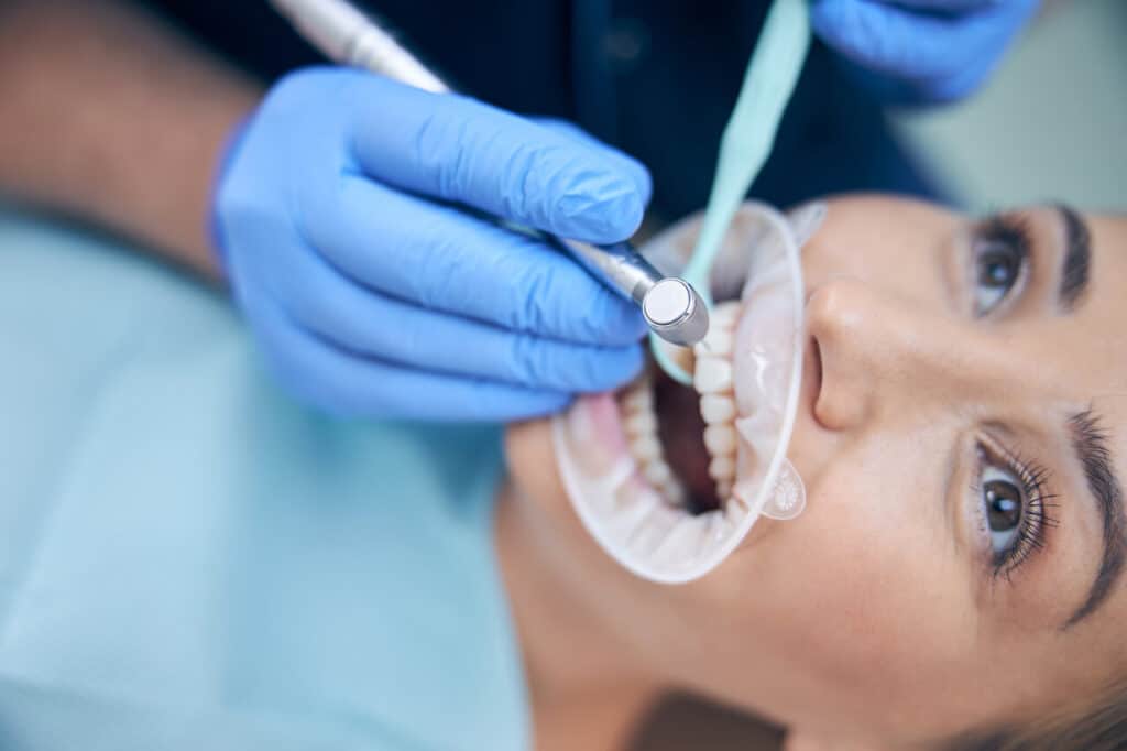 dental fillings