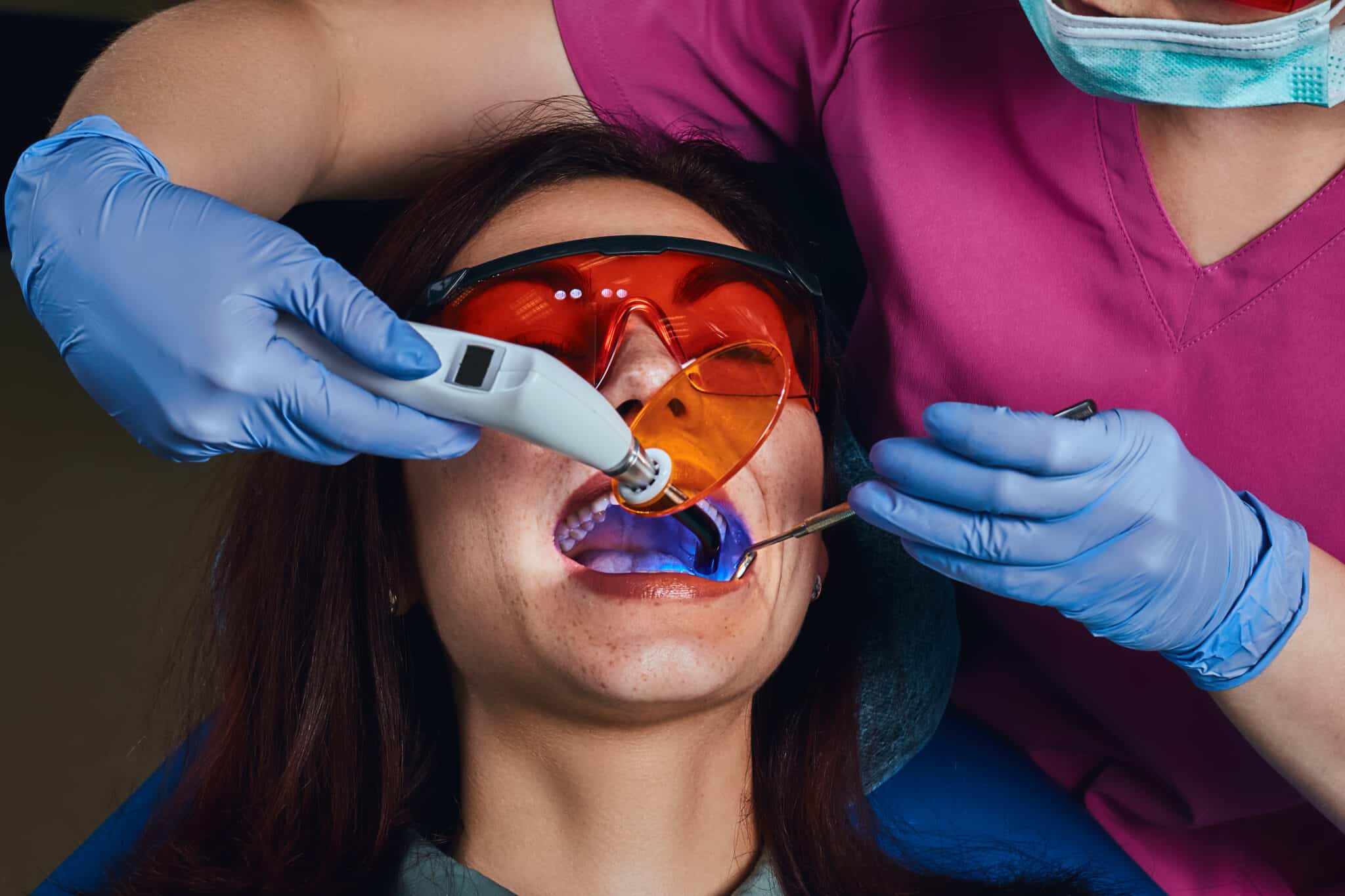 Tooth-Coloured-Dental-Fillings