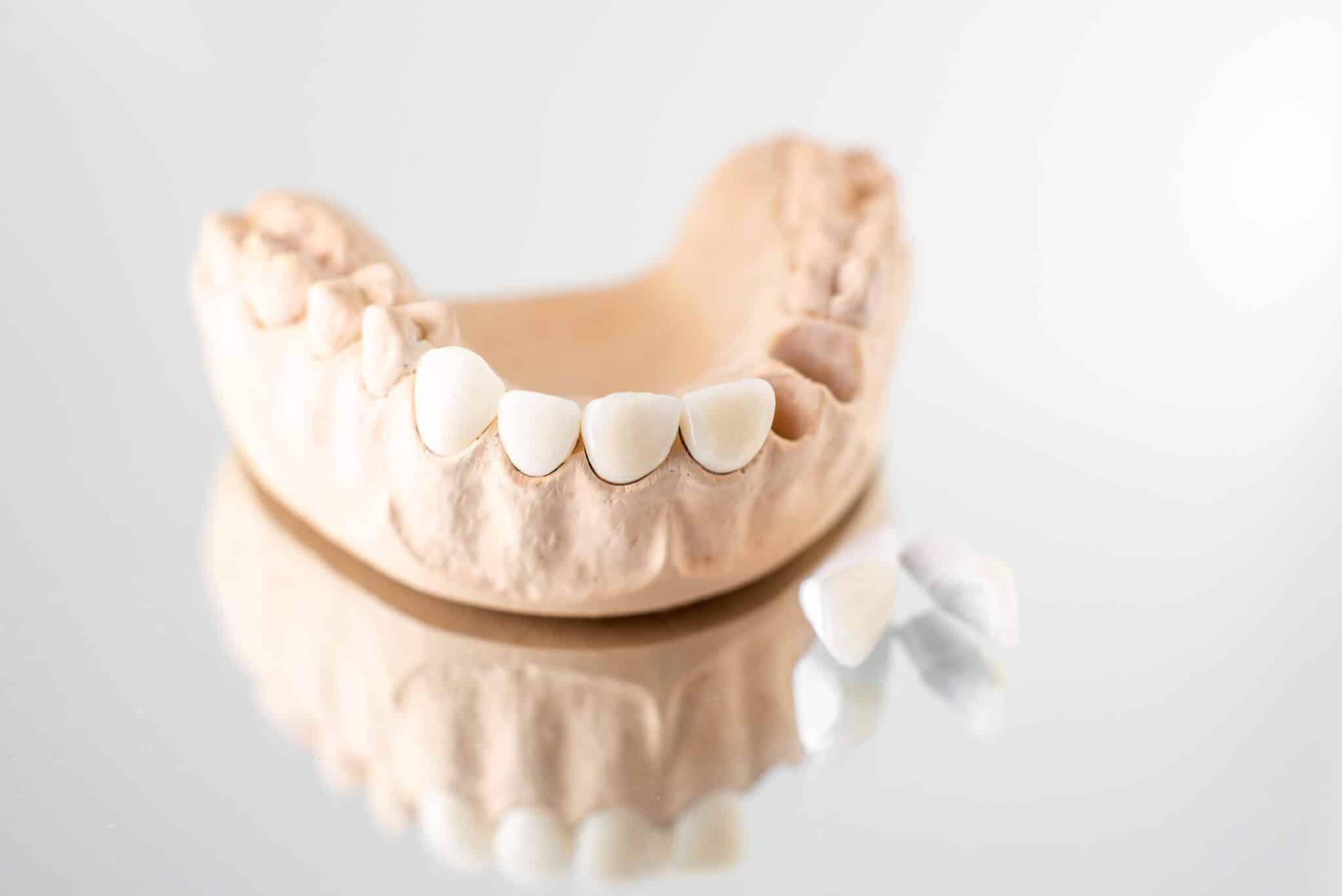 Dental-Bridges