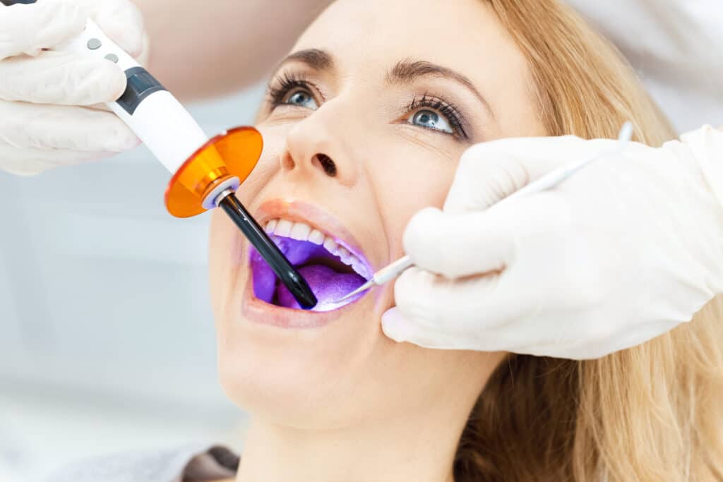 Tooth-Coloured-Fillings