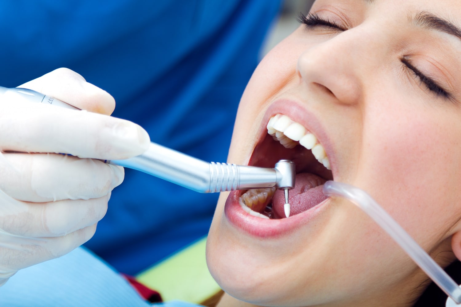 Tooth Coloured Fillings — Pickering, ON