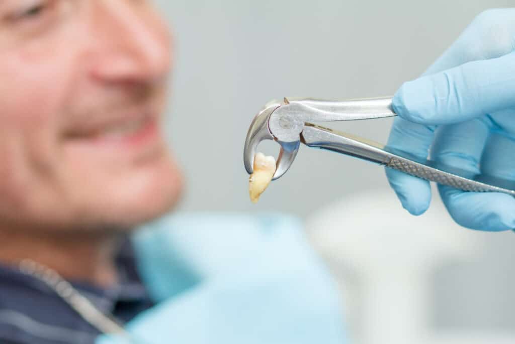 Dental Extractions