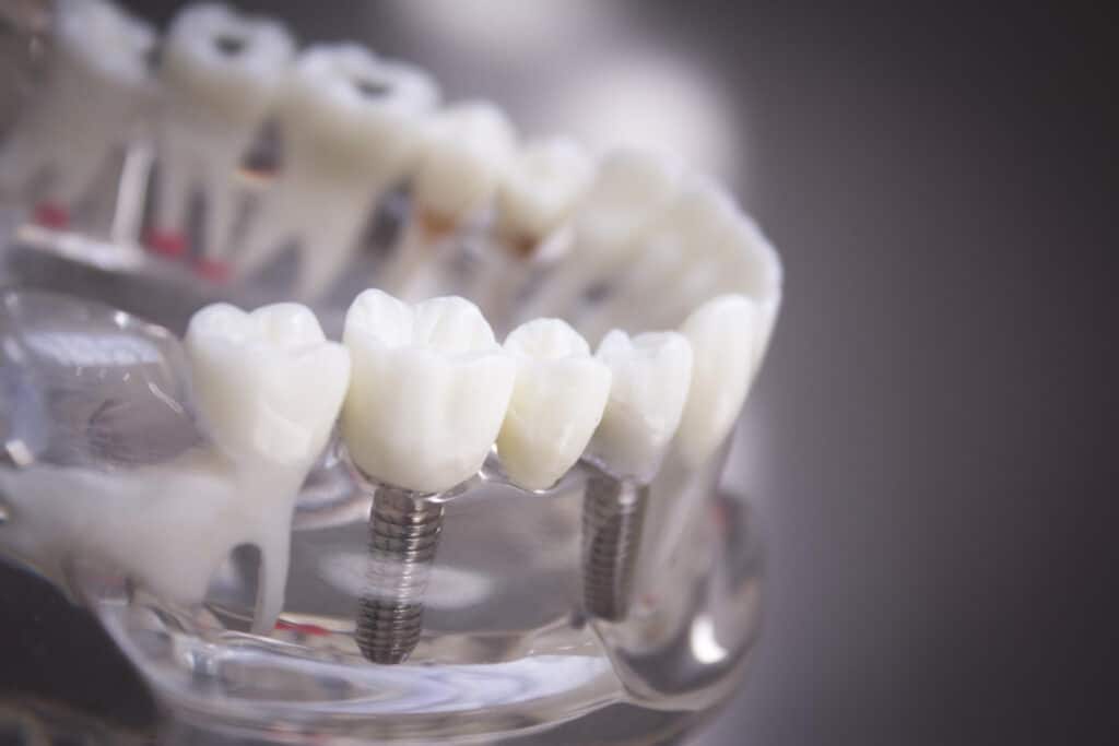 Dental Implants